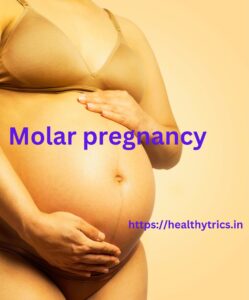 molar pregnancy